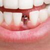 The Impact of Dental Implants on Speech and Eating