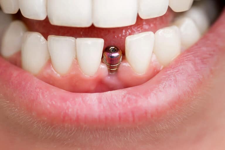 The Impact of Dental Implants on Speech and Eating