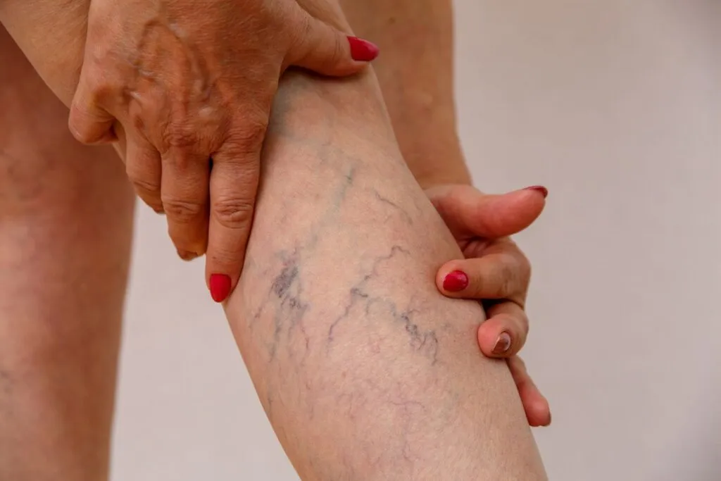Understanding the Risks Associated With Varicose Veins