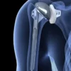What Is Total Shoulder Replacement?
