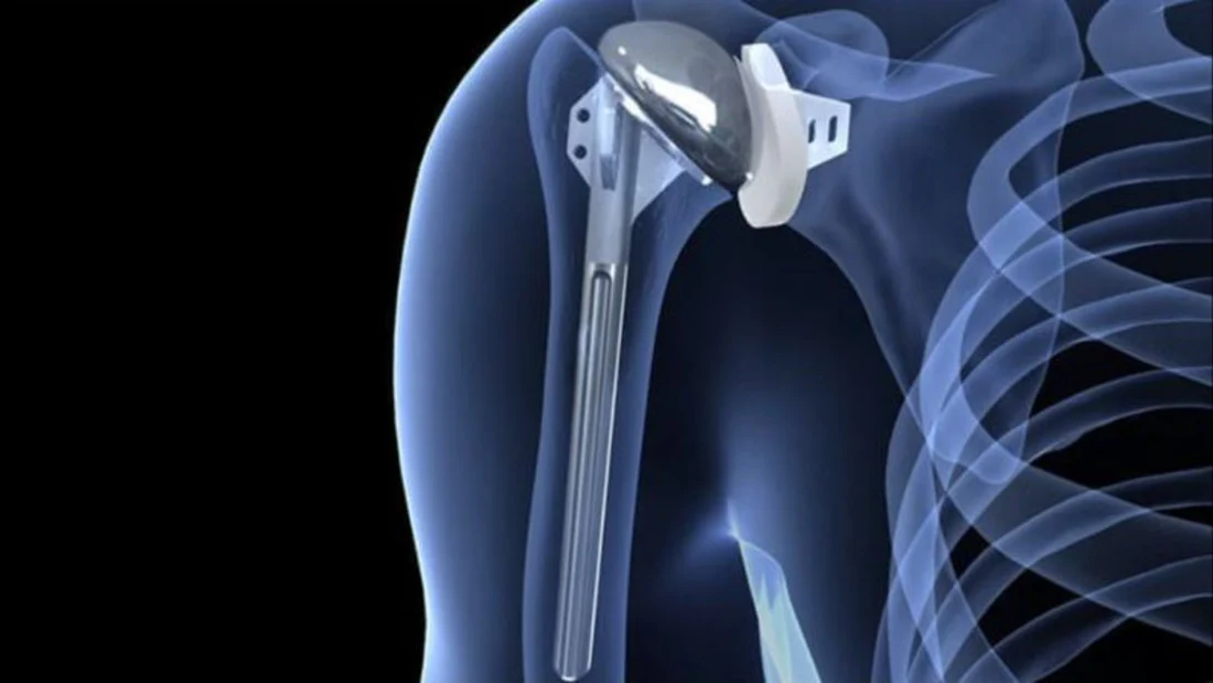 What Is Total Shoulder Replacement?